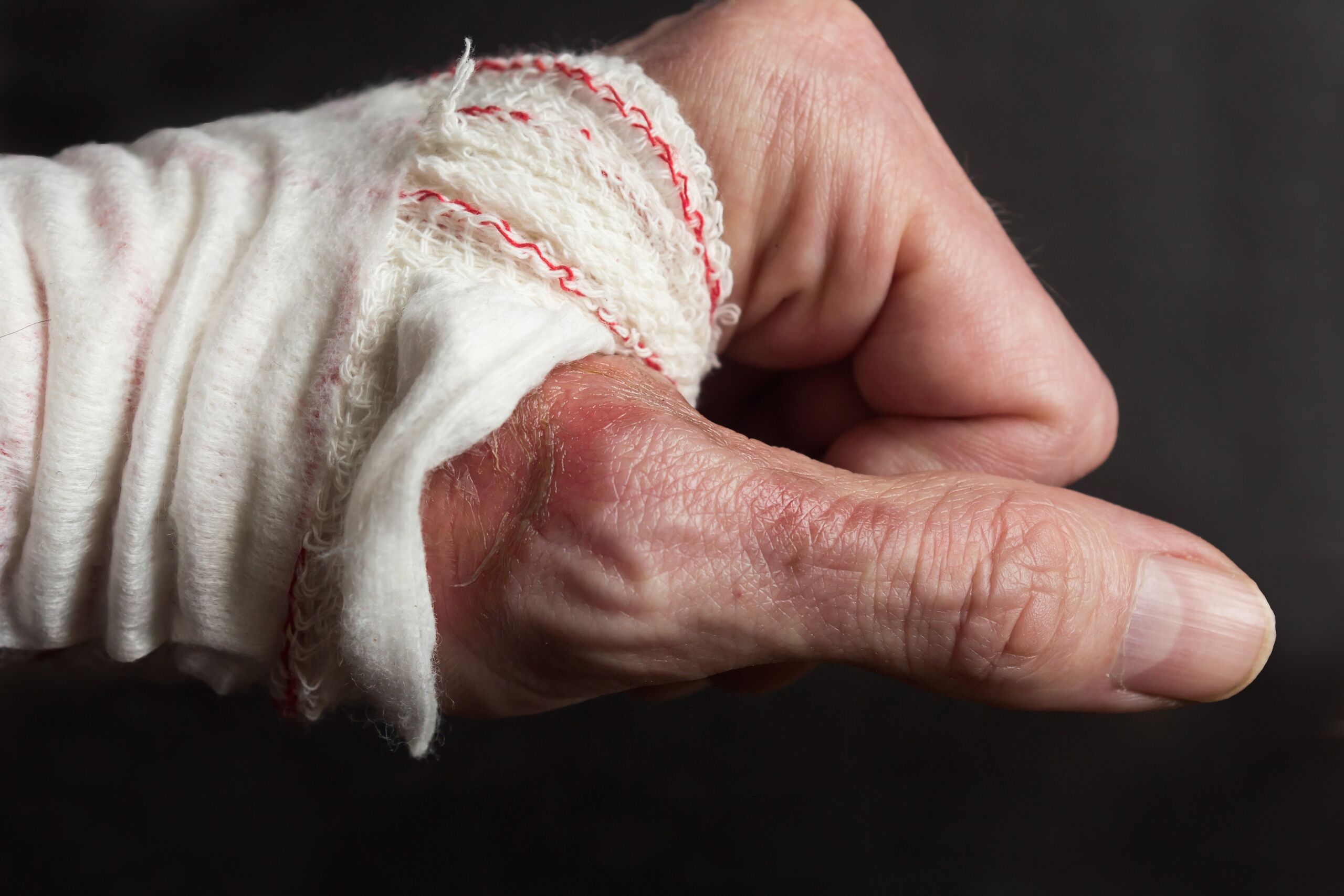 Worker with a severe burn injury on hand after a workplace accident in Hampden County requiring ongoing medical treatment and recovery